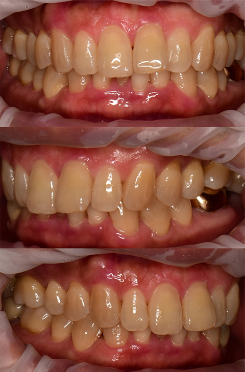 Lee Youngjun laminate before image